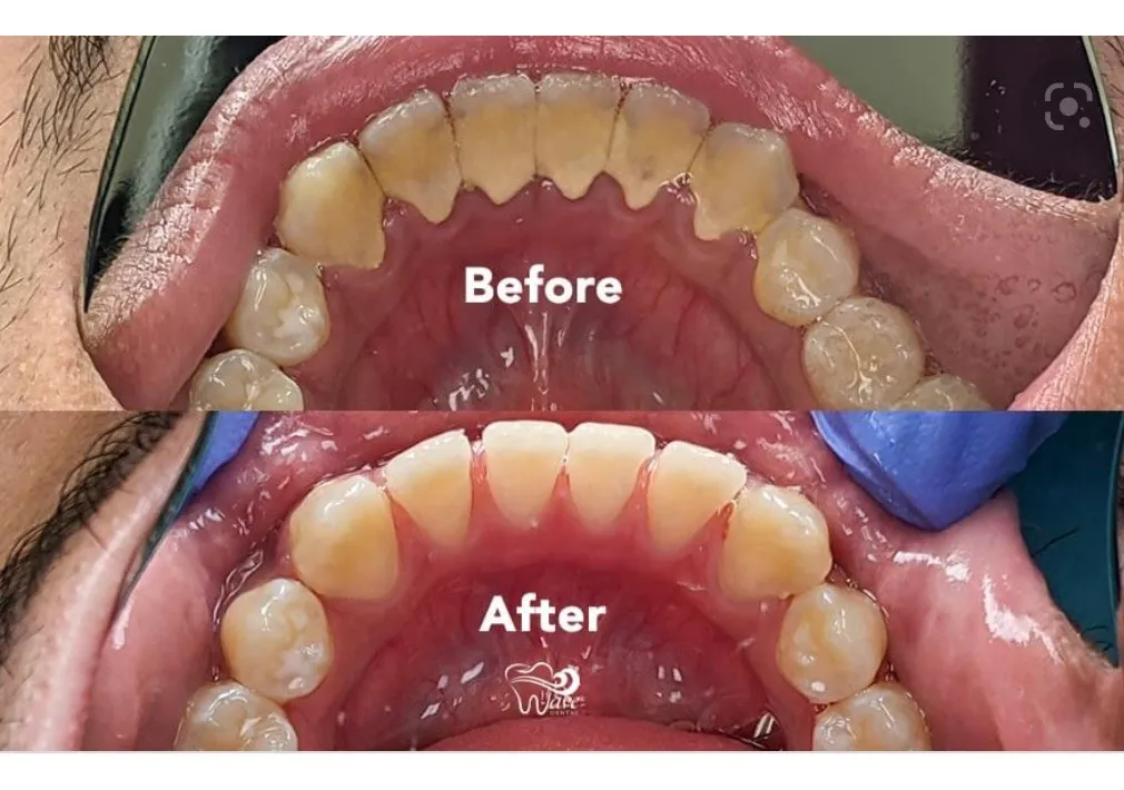 Teeth Cleaning photo 1