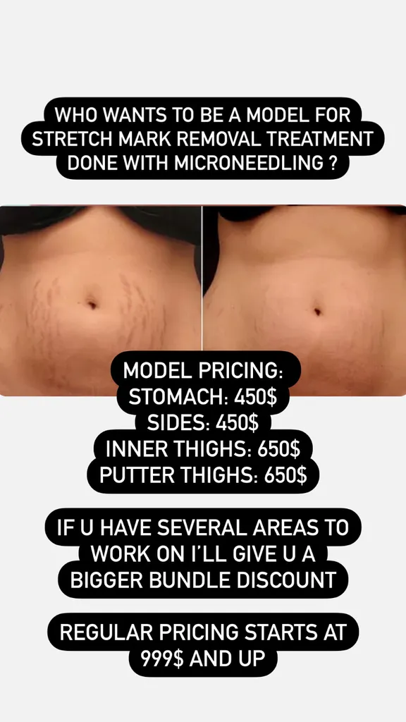 Models needed stretch mark removal  photo 1