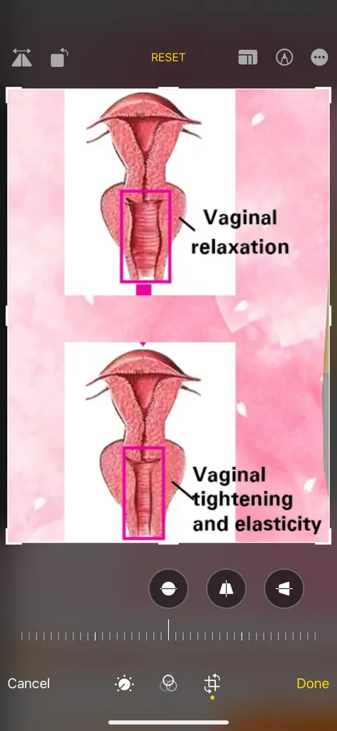 vaginal tightening treatment (professional)  photo 1